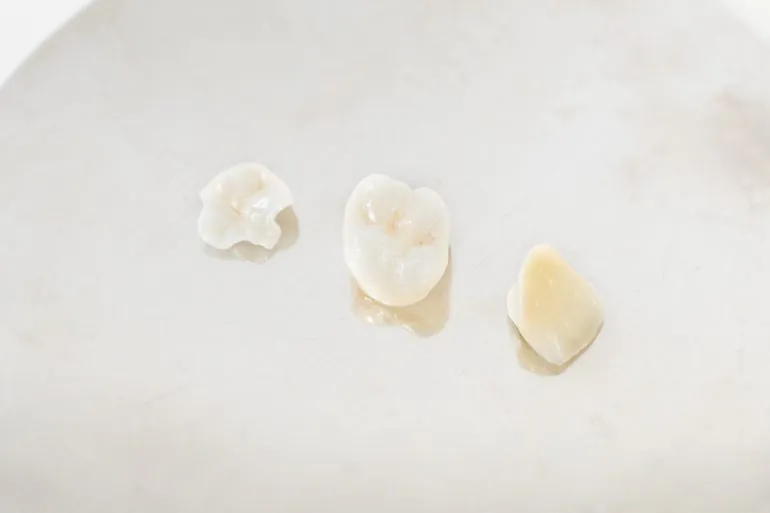 根管治療の再発性を防ぐには、被せ物の精度も重要